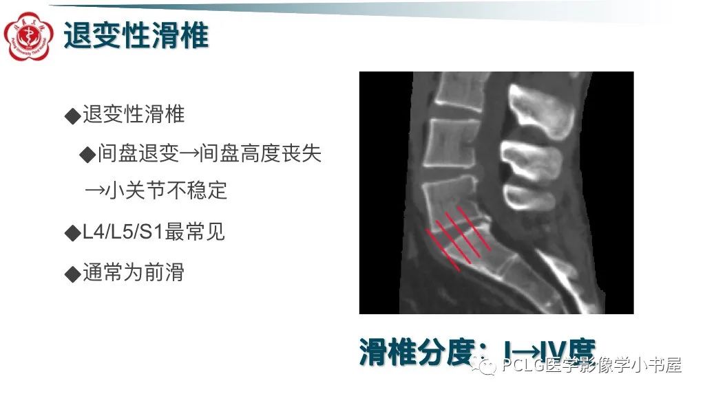 影像PPT - 【PPT】腰椎退行性病变影像读片思路-5