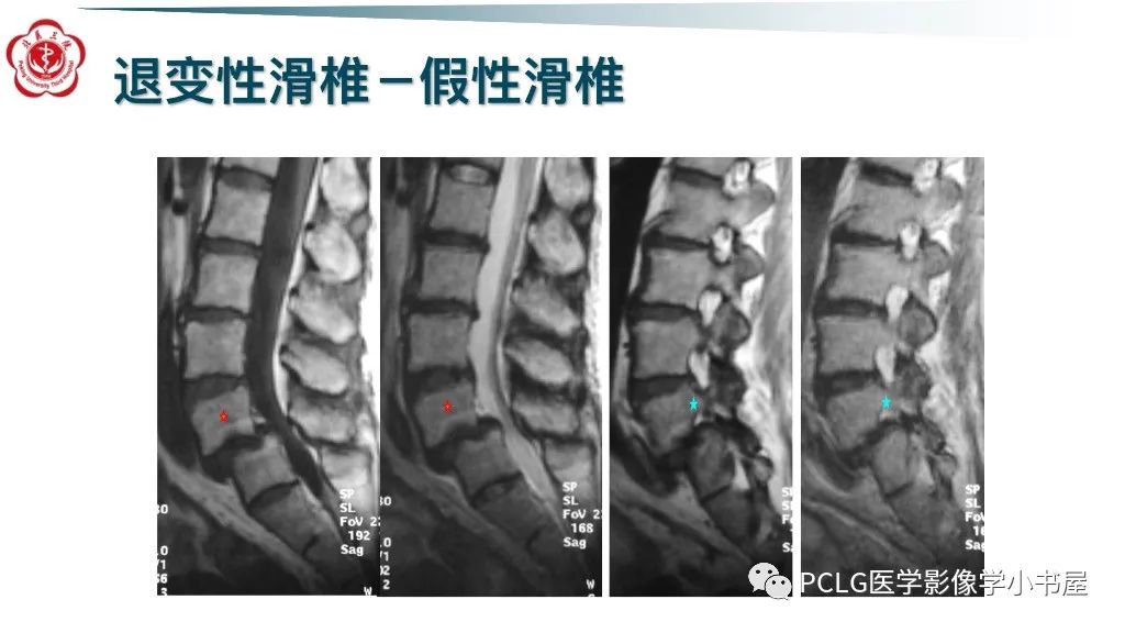 影像PPT - 【PPT】腰椎退行性病变影像读片思路-6