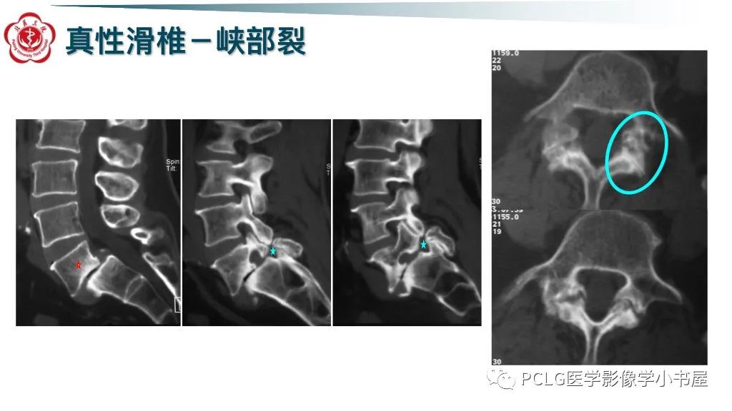 影像PPT - 【PPT】腰椎退行性病变影像读片思路-7