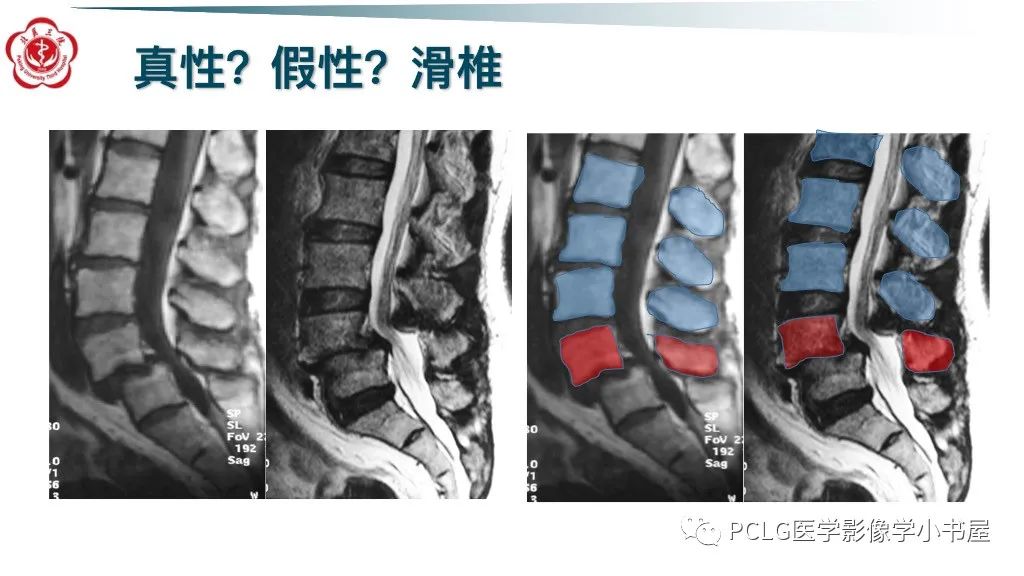 影像PPT - 【PPT】腰椎退行性病变影像读片思路-8