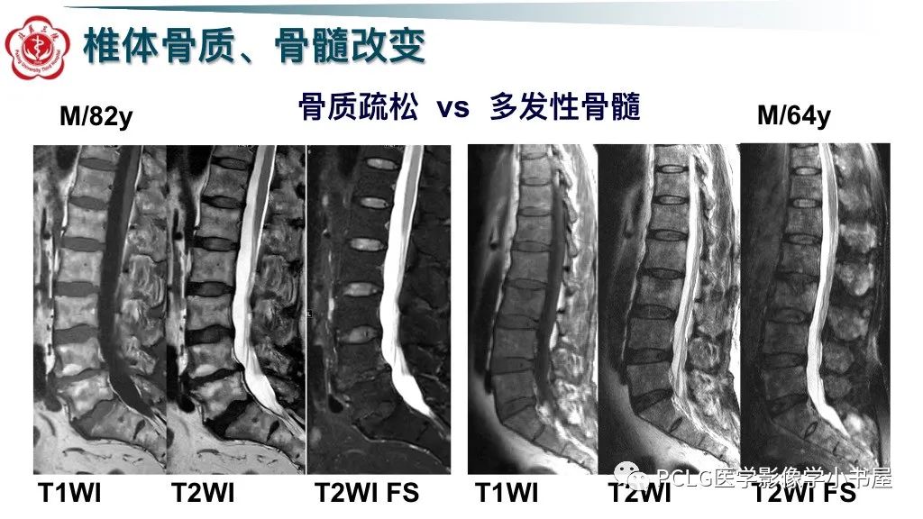 影像PPT - 【PPT】腰椎退行性病变影像读片思路-9