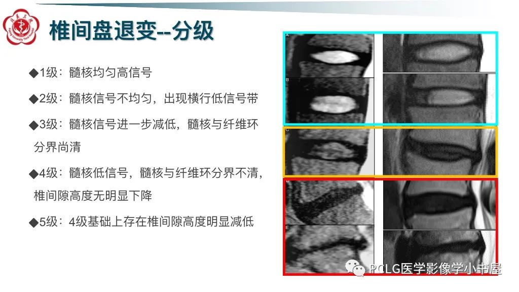 影像PPT - 【PPT】腰椎退行性病变影像读片思路-10