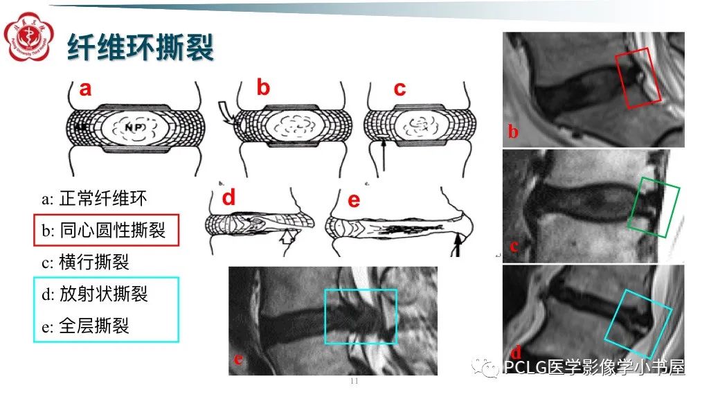 影像PPT - 【PPT】腰椎退行性病变影像读片思路-11