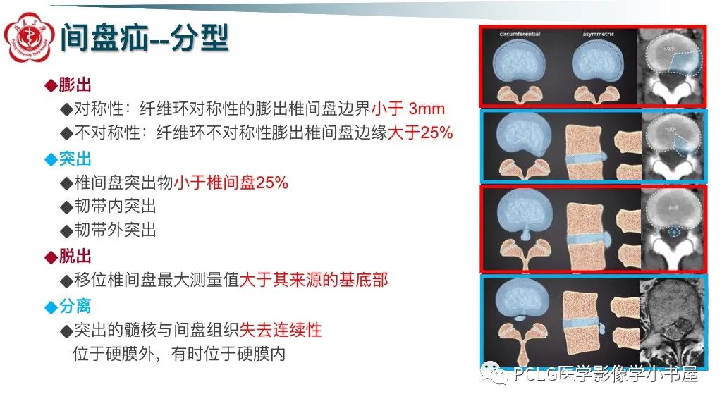 影像PPT - 【PPT】腰椎退行性病变影像读片思路-12