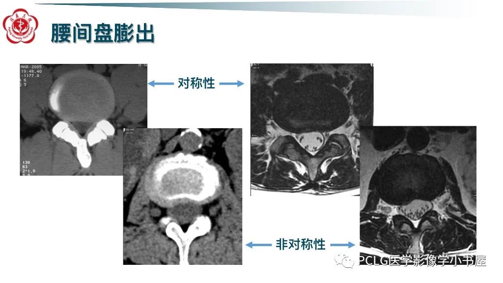 影像PPT - 【PPT】腰椎退行性病变影像读片思路-13