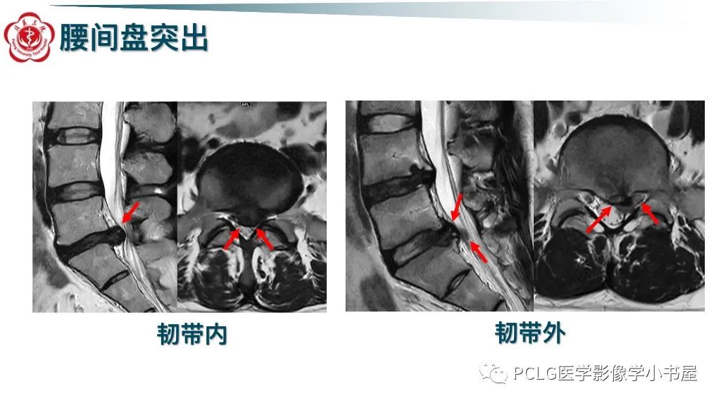 影像PPT - 【PPT】腰椎退行性病变影像读片思路-14