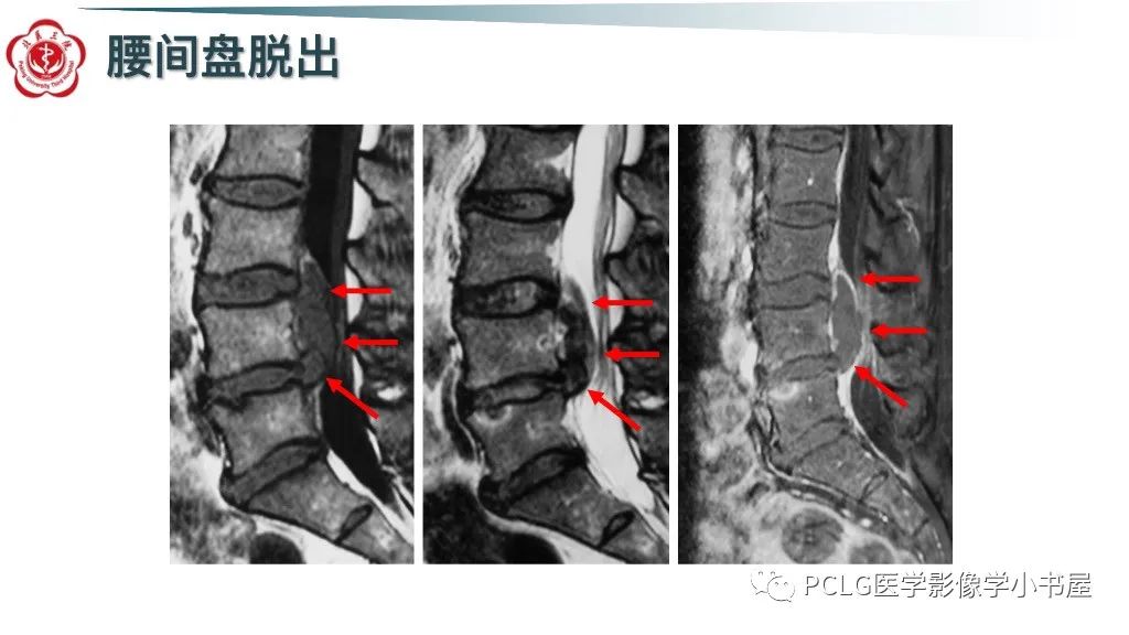 影像PPT - 【PPT】腰椎退行性病变影像读片思路-15