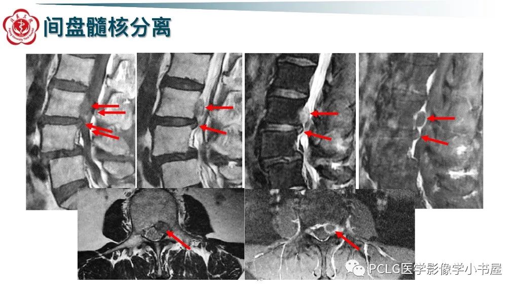 影像PPT - 【PPT】腰椎退行性病变影像读片思路-16