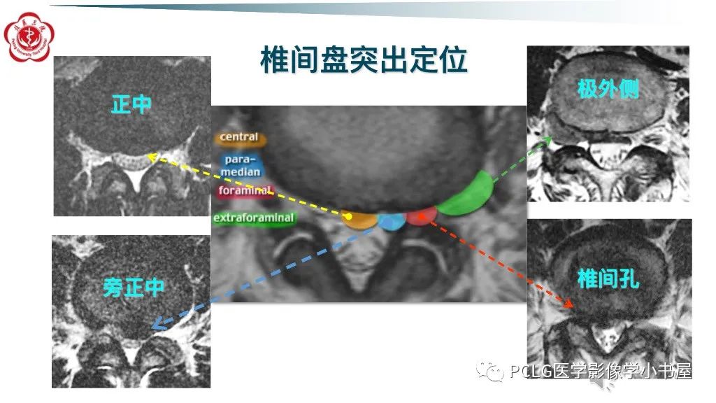 影像PPT - 【PPT】腰椎退行性病变影像读片思路-17