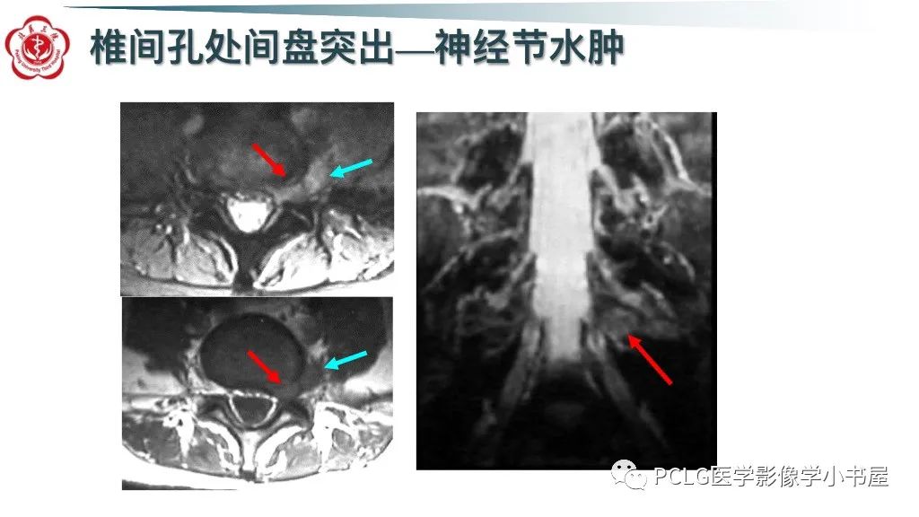 影像PPT - 【PPT】腰椎退行性病变影像读片思路-18