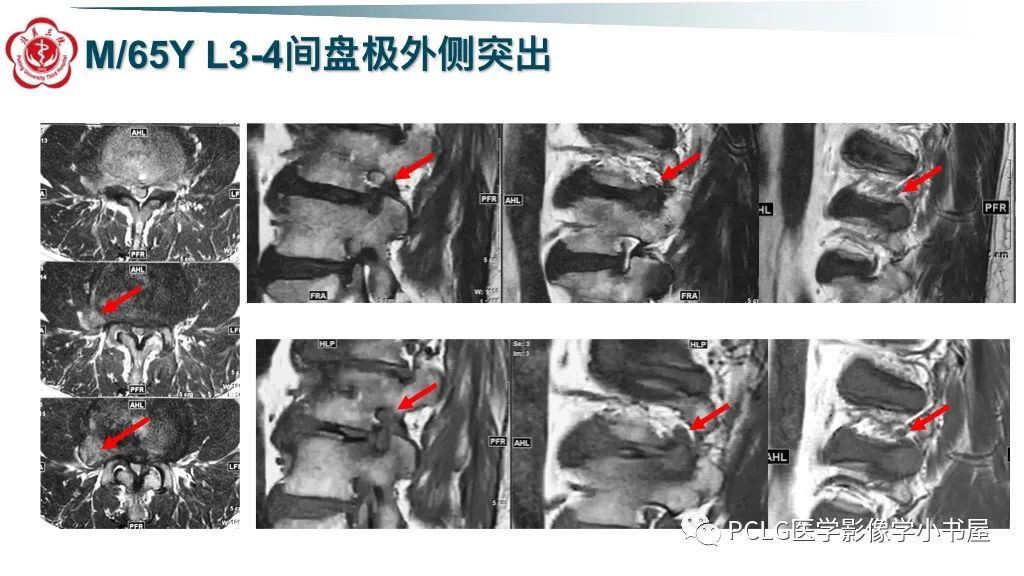 影像PPT - 【PPT】腰椎退行性病变影像读片思路-19