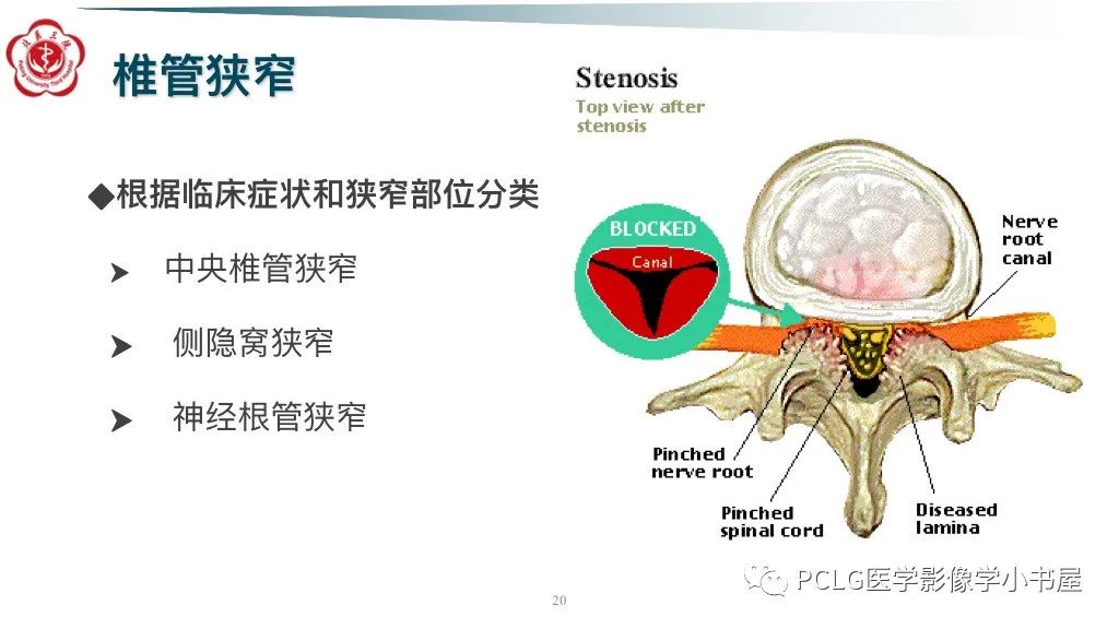 影像PPT - 【PPT】腰椎退行性病变影像读片思路-20