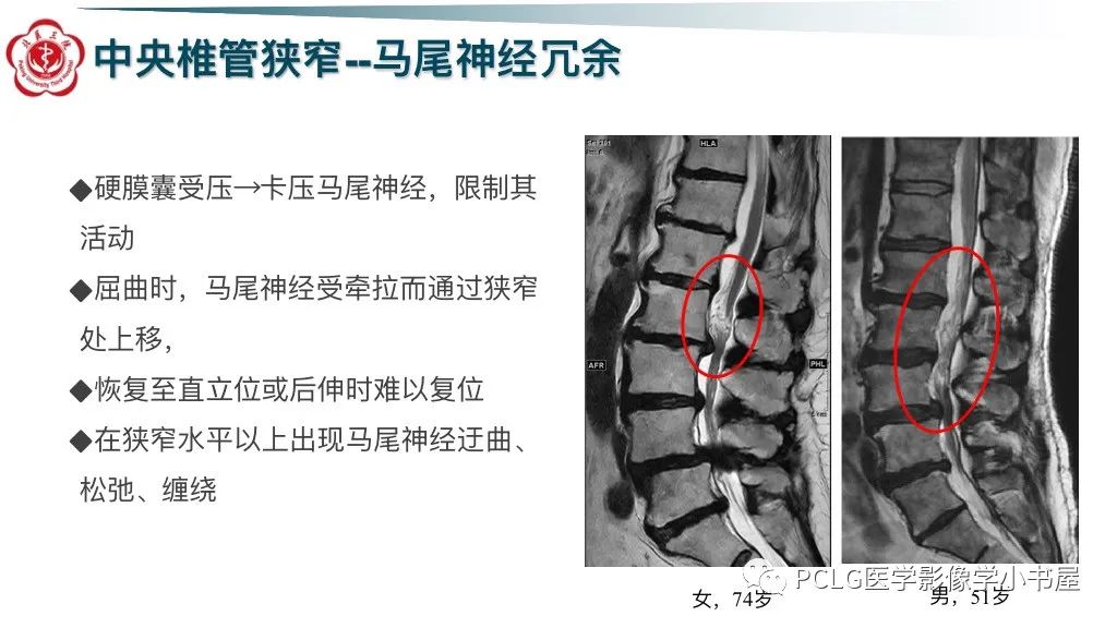 影像PPT - 【PPT】腰椎退行性病变影像读片思路-21
