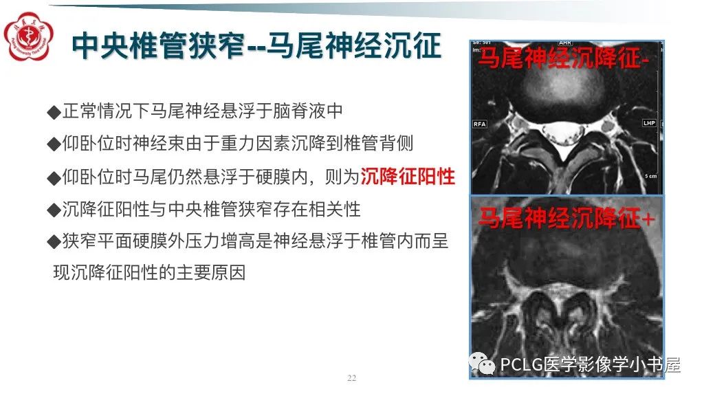 影像PPT - 【PPT】腰椎退行性病变影像读片思路-22