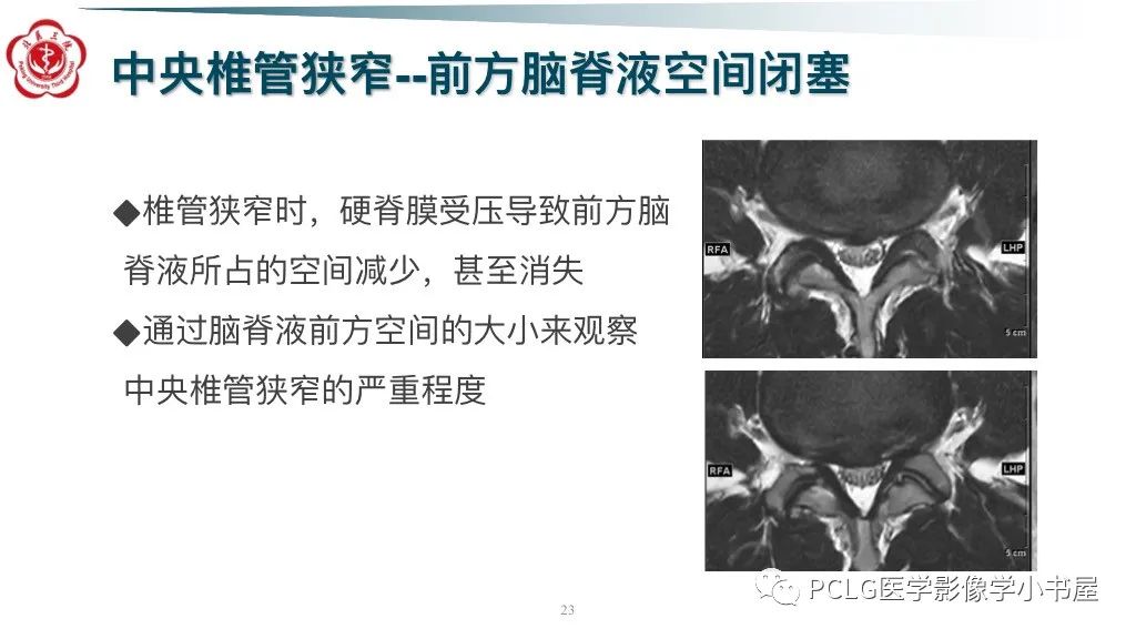 影像PPT - 【PPT】腰椎退行性病变影像读片思路-23