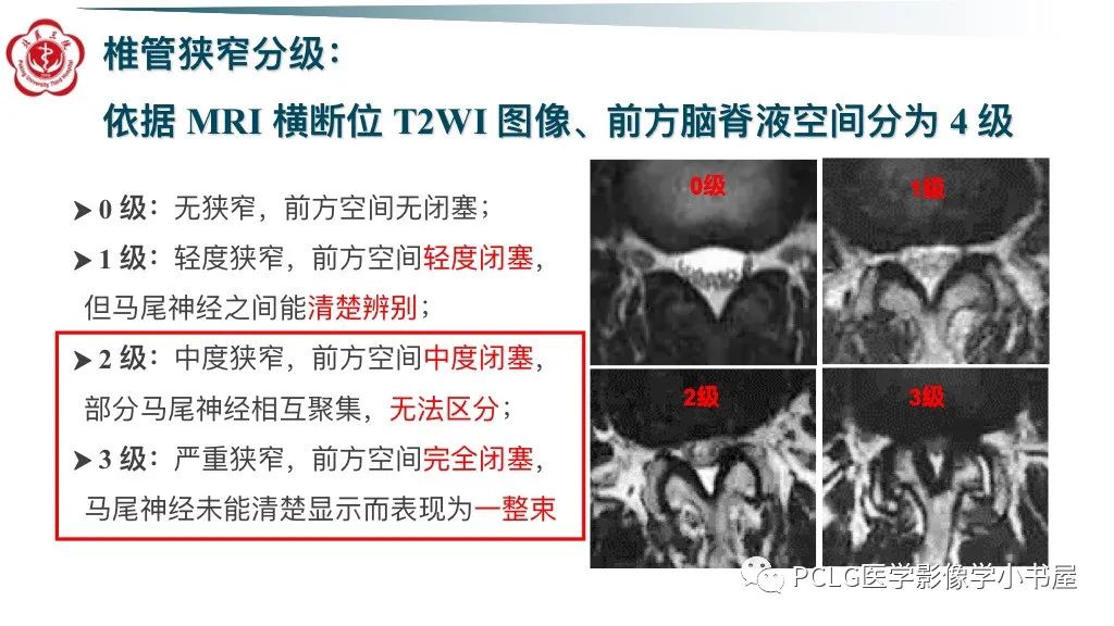 影像PPT - 【PPT】腰椎退行性病变影像读片思路-24