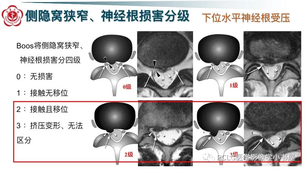 影像PPT - 【PPT】腰椎退行性病变影像读片思路-25