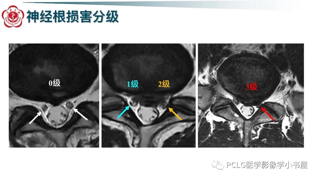 影像PPT - 【PPT】腰椎退行性病变影像读片思路-26