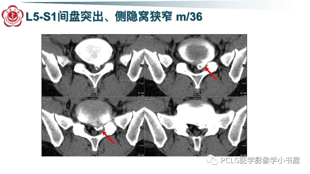 影像PPT - 【PPT】腰椎退行性病变影像读片思路-27