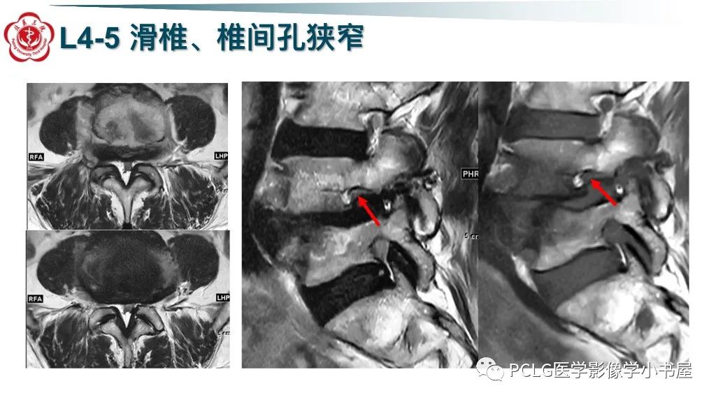 影像PPT - 【PPT】腰椎退行性病变影像读片思路-31