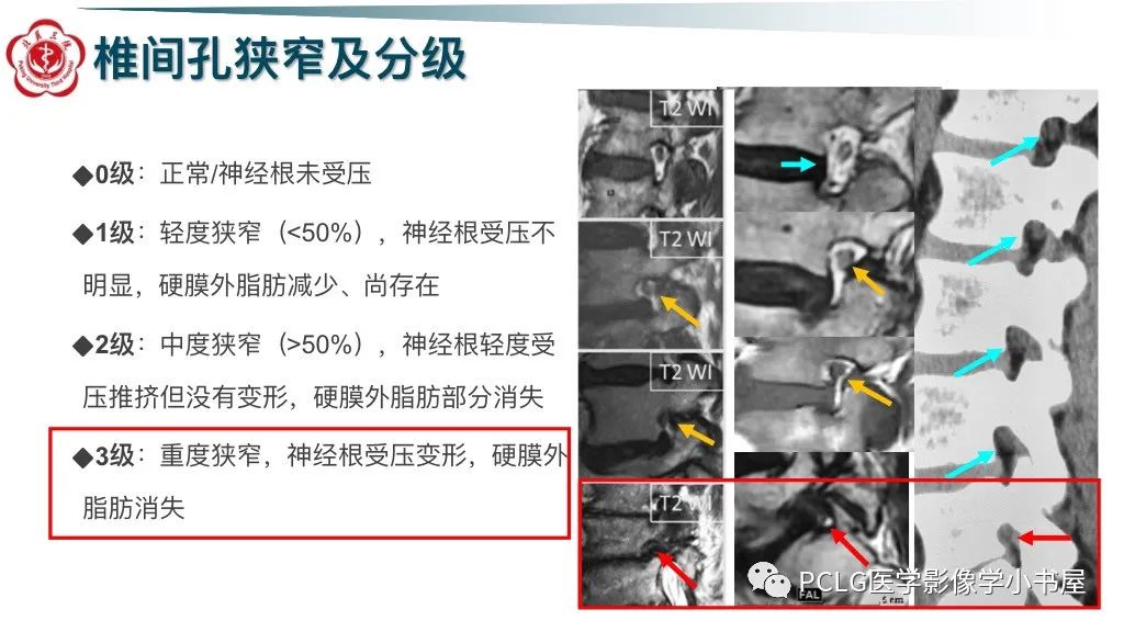 影像PPT - 【PPT】腰椎退行性病变影像读片思路-28