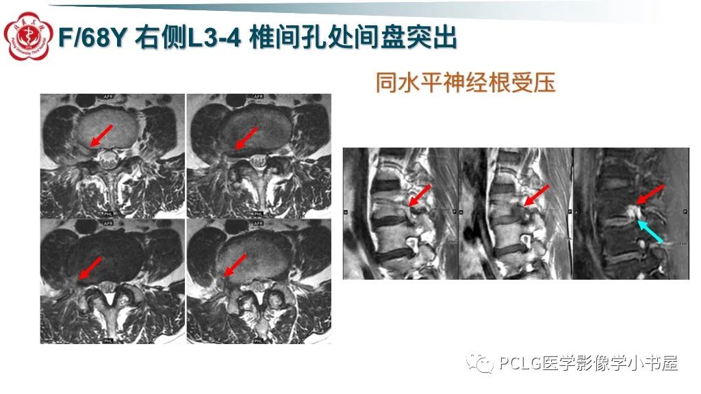 影像PPT - 【PPT】腰椎退行性病变影像读片思路-29