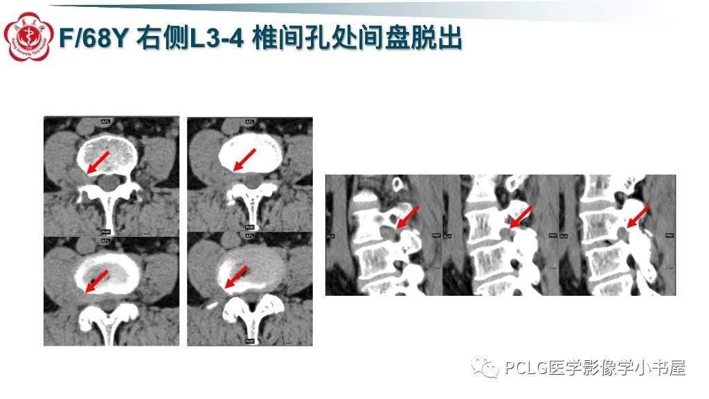 影像PPT - 【PPT】腰椎退行性病变影像读片思路-30