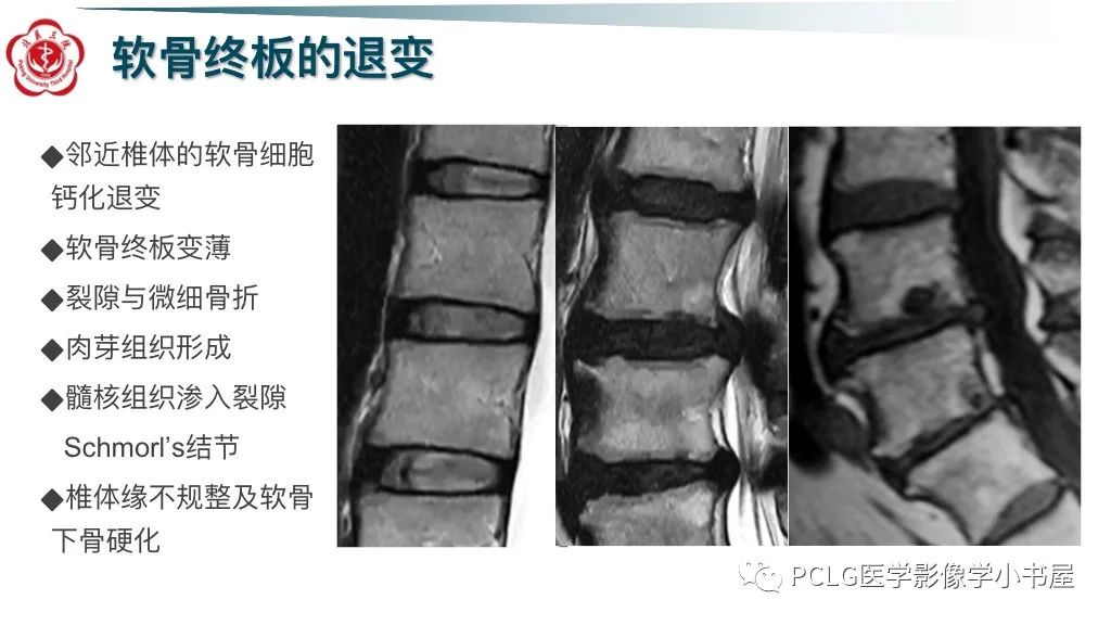 影像PPT - 【PPT】腰椎退行性病变影像读片思路-32