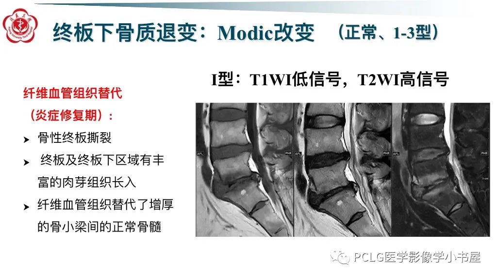 影像PPT - 【PPT】腰椎退行性病变影像读片思路-33