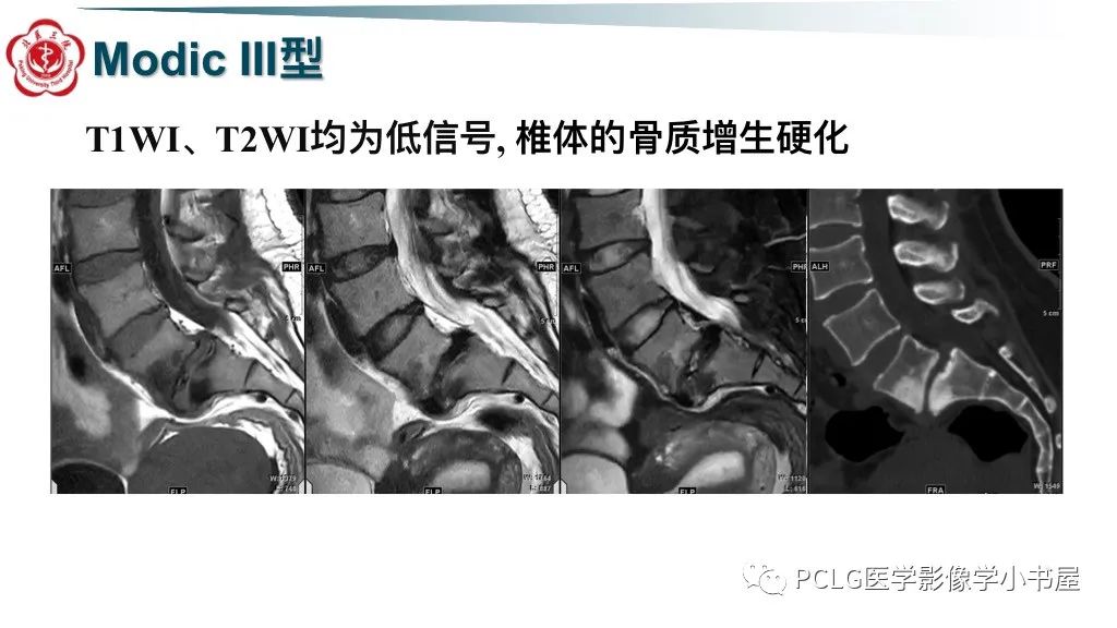 影像PPT - 【PPT】腰椎退行性病变影像读片思路-35
