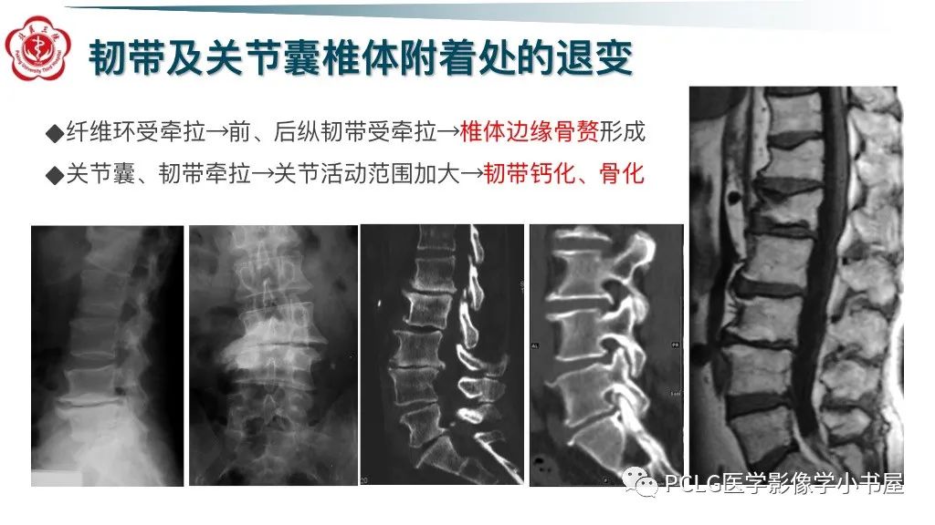 影像PPT - 【PPT】腰椎退行性病变影像读片思路-36