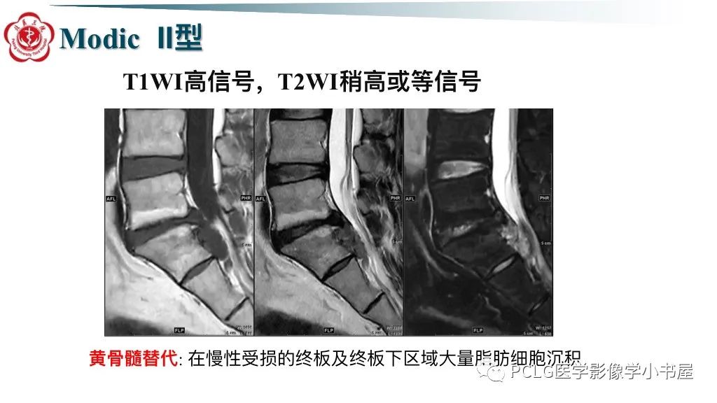影像PPT - 【PPT】腰椎退行性病变影像读片思路-34