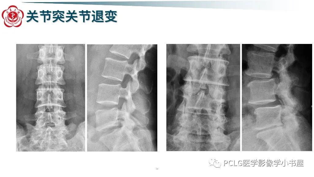 影像PPT - 【PPT】腰椎退行性病变影像读片思路-38