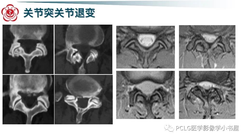 影像PPT - 【PPT】腰椎退行性病变影像读片思路-39