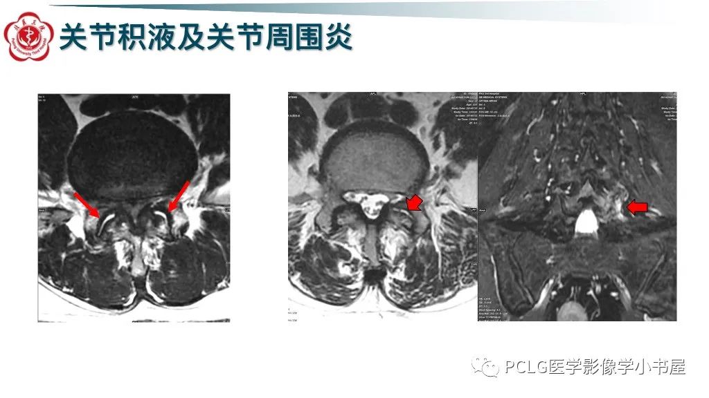影像PPT - 【PPT】腰椎退行性病变影像读片思路-40