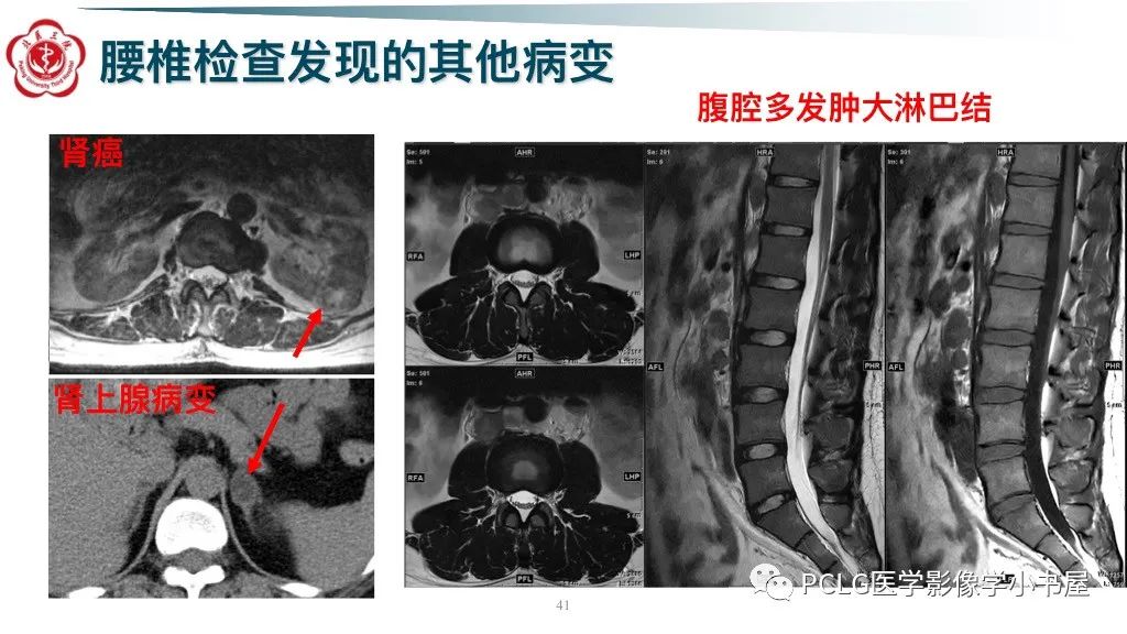 影像PPT - 【PPT】腰椎退行性病变影像读片思路-41