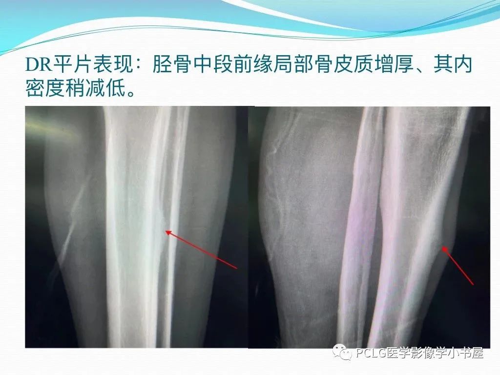 影像PPT - 【PPT】骨样骨瘤-3