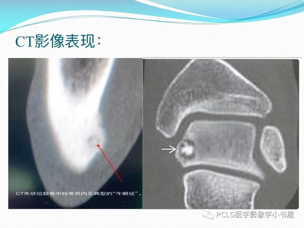 影像PPT - 【PPT】骨样骨瘤-4