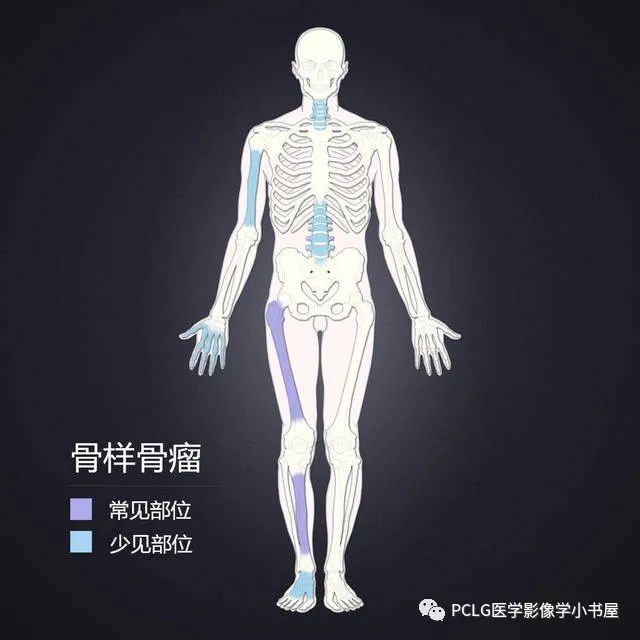 影像PPT - 【PPT】骨样骨瘤-13