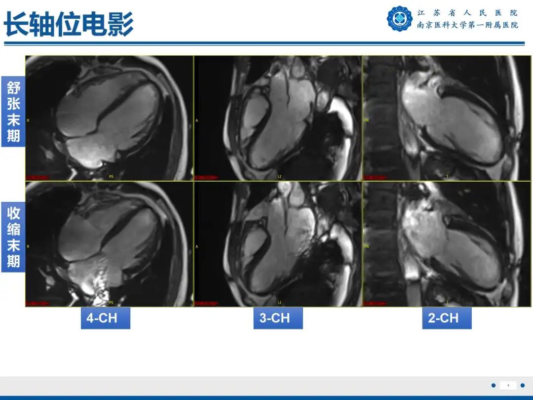 影像PPT - 【PPT】铁过载心肌病-6