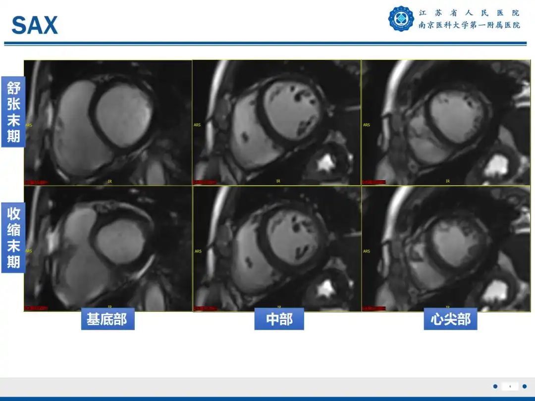 影像PPT - 【PPT】铁过载心肌病-7