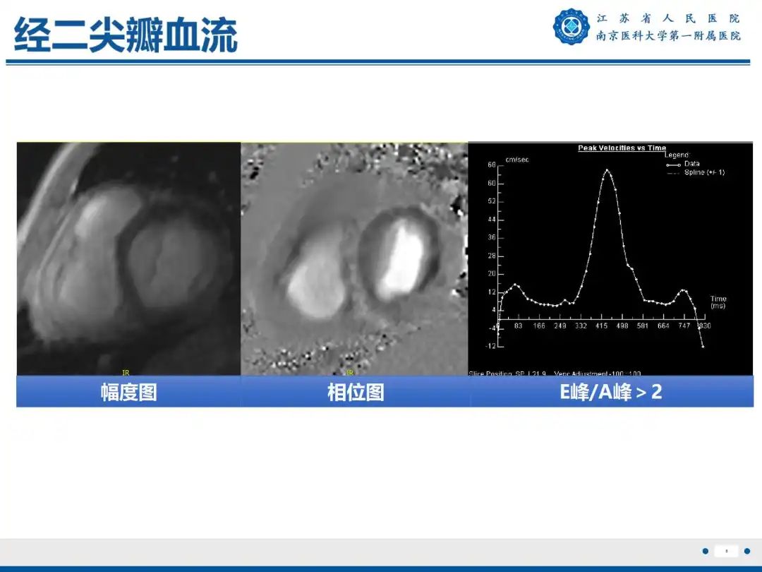 影像PPT - 【PPT】铁过载心肌病-9