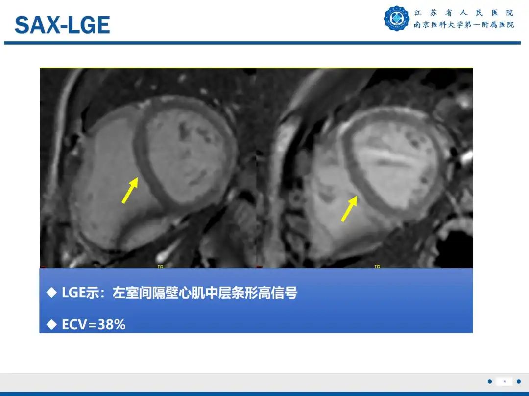 影像PPT - 【PPT】铁过载心肌病-11