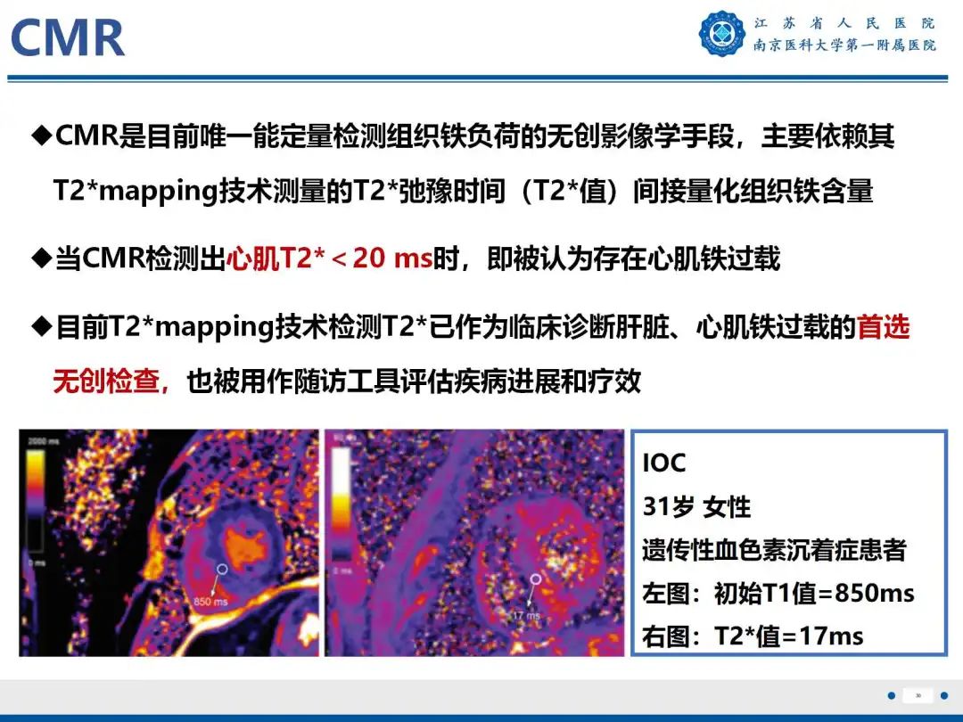 影像PPT - 【PPT】铁过载心肌病-31
