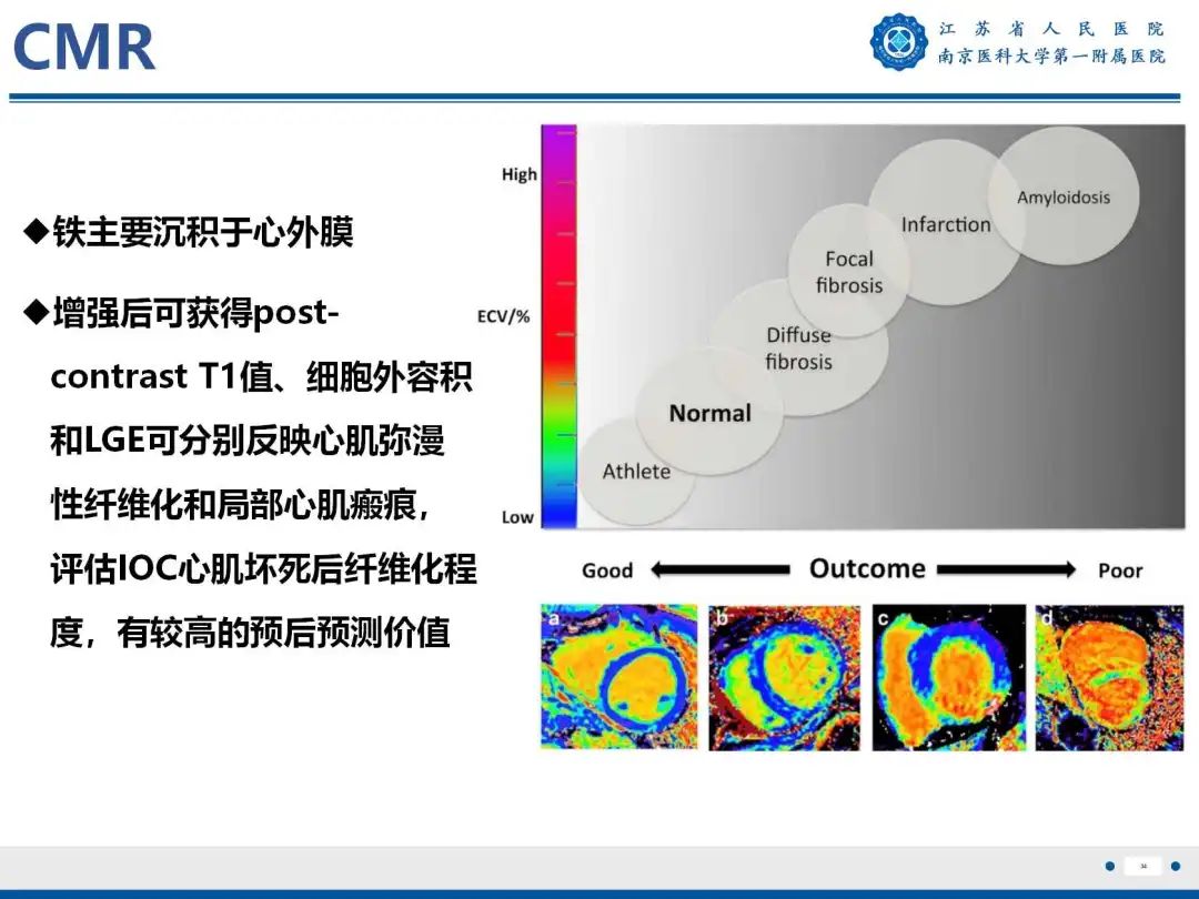 影像PPT - 【PPT】铁过载心肌病-35