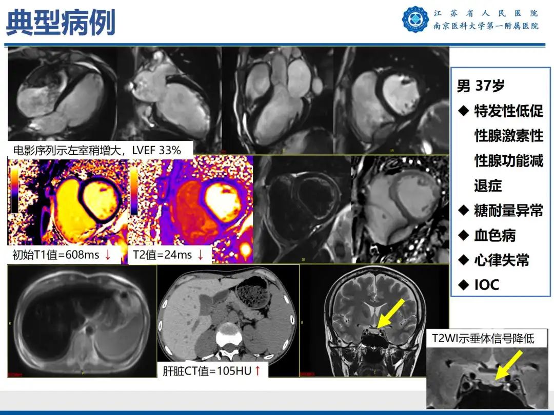 影像PPT - 【PPT】铁过载心肌病-37