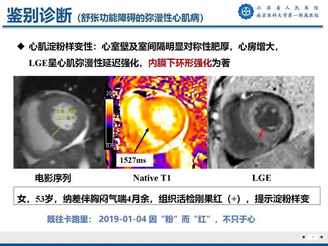 影像PPT - 【PPT】铁过载心肌病-38