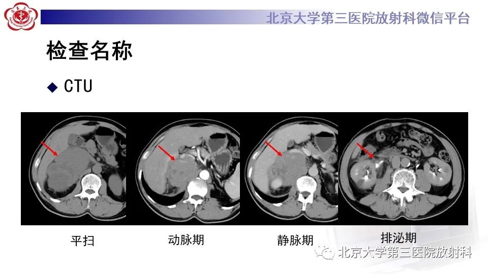 影像PPT - 【PPT】原发性肾上腺淋巴瘤-3