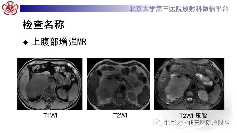 影像PPT - 【PPT】原发性肾上腺淋巴瘤-5