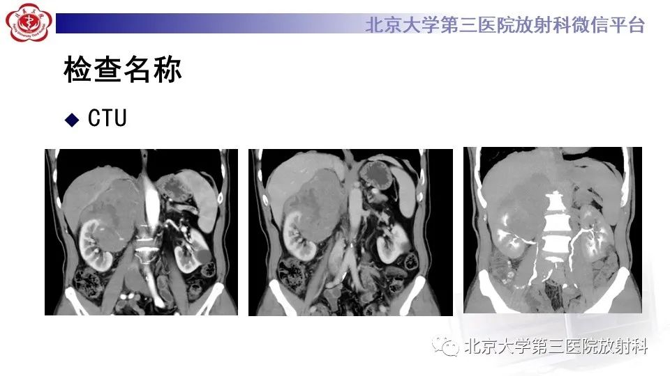 影像PPT - 【PPT】原发性肾上腺淋巴瘤-4